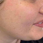Acne Before and After Case 16 After