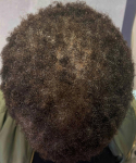 Exoflo Hair Restoration Before and After Case 5 After