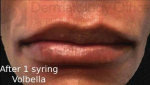 Volbella (1 syringe) Before and After Case 6 After