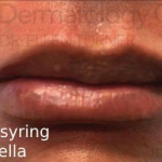 Volbella (1 syringe) Before and After Case 6 After