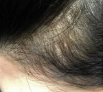 Exoflo Hair Restoration Before and After Case 8 Before