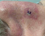 Skin Cancer Before and After Case 25 Before