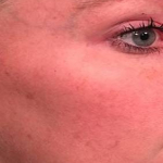 IPL-Photofacial/BBL Before and After Case 7 After