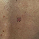 Skin Cancer Before and After Case 26 Before