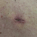 Skin Cancer Before and After Case 26 After