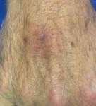 Skin Cancer Before and After Case 27 After