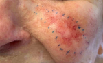 Skin Cancer Before and After Case 28 After