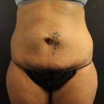 CoolSculpting<sup>®</sup> Before and After Case 1 Before