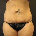 CoolSculpting<sup>®</sup> Before and After Case 1 After