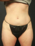 CoolSculpting<sup>®</sup> Before and After Case 2 Before