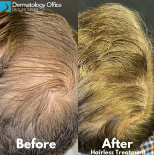 Hair Loss Before and After 11 