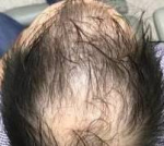 Hair Loss Before and After 12 Before