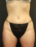 CoolSculpting<sup>®</sup> Before and After Case 2 After