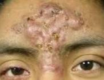 Acne Before and After 19 Before