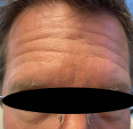Botox Before and After 24 Before