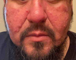 Rosacea Before And After 29 