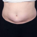CoolSculpting<sup>®</sup> Before and After Case 3 Before