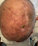 Skin Cancer Before and After Case 32 Before