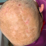 Skin Cancer Before and After Case 32 After