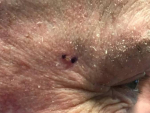 Skin Cancer Before and After 34 Before