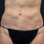 CoolSculpting<sup>®</sup> Before and After Case 3 After