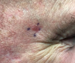 Skin Cancer Before and After 34 After