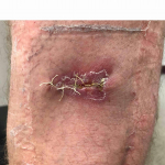 Skin Cancer Before and After 33 After