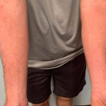 Eczema/ Atopic Dermatitis Before and After 18 After