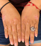 Psoriasis Before and After 33 Before