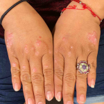 Psoriasis Before and After 33 Before
