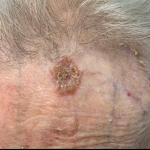 Skin Cancer Before and After Case-31 Before