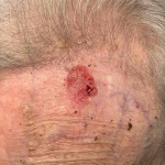 Skin Cancer Before and After Case-31 After