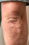 Psoriasis Before and After 34 Before