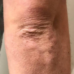 Psoriasis Before and After 34 Before