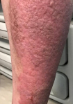 Psoriasis Before and After Case 33 Before