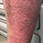 Psoriasis Before and After Case 33 Before