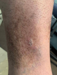 Psoriasis Before and After Case 33 After
