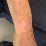 Psoriasis Before and After 36 Before