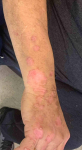 Psoriasis Before and After 37 Before
