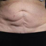 CoolSculpting<sup>®</sup> Before and After Case 6 Before