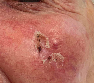 Skin Cancer Before and After Case-32 