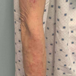 Atopic Dermatitis Before and After 19 Before