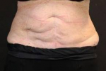 CoolSculpting<sup>®</sup> Before and After Case 6 After