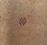 Skin Cancer Before and After Case-33 Before