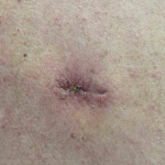 Skin Cancer Before and After Case-33 After
