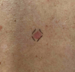 Skin Cancer Before and After 40 Before