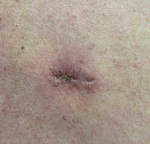 Skin Cancer Before and After 40 After