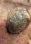 Skin Cancer Before and After 41 Before
