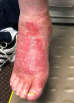 Eczema/ Atopic Dermatitis Before and After 20 Before