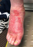 Eczema/ Atopic Dermatitis Before and After 42 Before